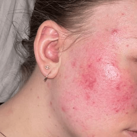 🐝 Kviser? Rosacea? - Vossabia